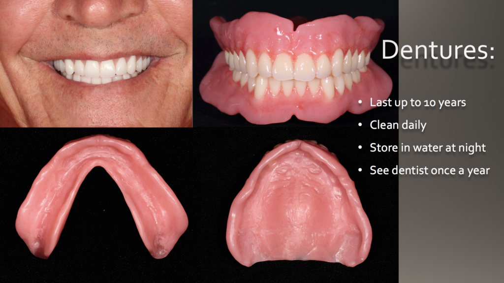 Custom full dentures showing a patient's smile and the detailed upper and lower prosthetic bases by Raleigh prosthodontist Dr. Hugh Murphy.