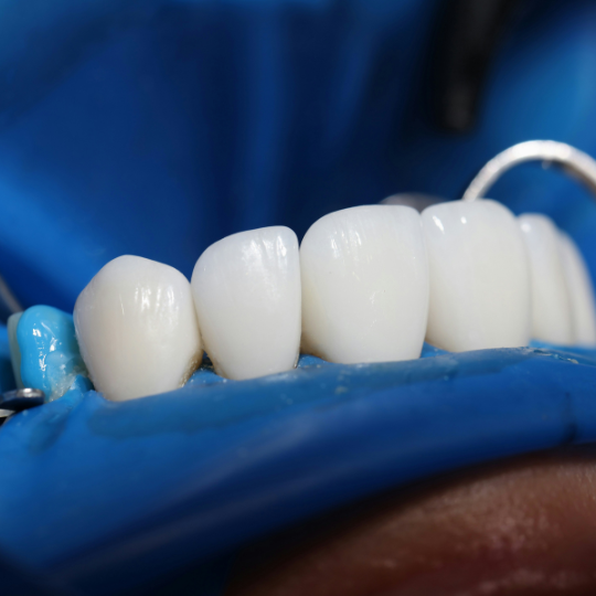 veneers