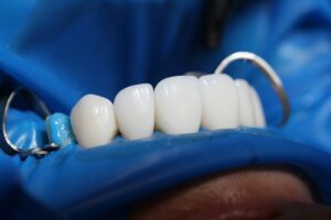 dentures