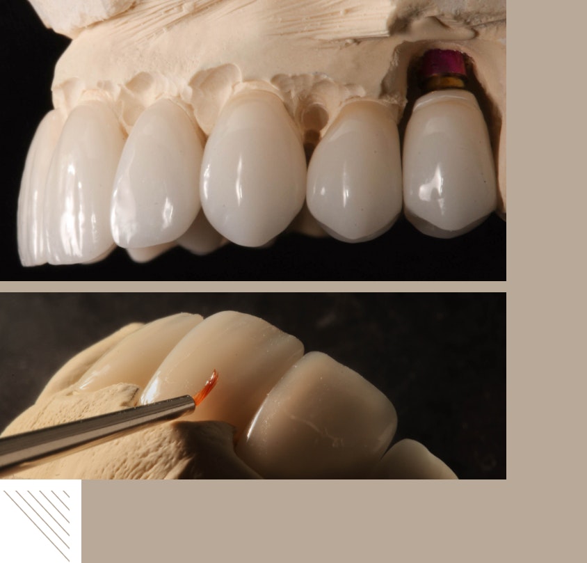 A dental technician's hand applying custom stain with a fine brush to a ceramic implant crown on a plaster dental model.