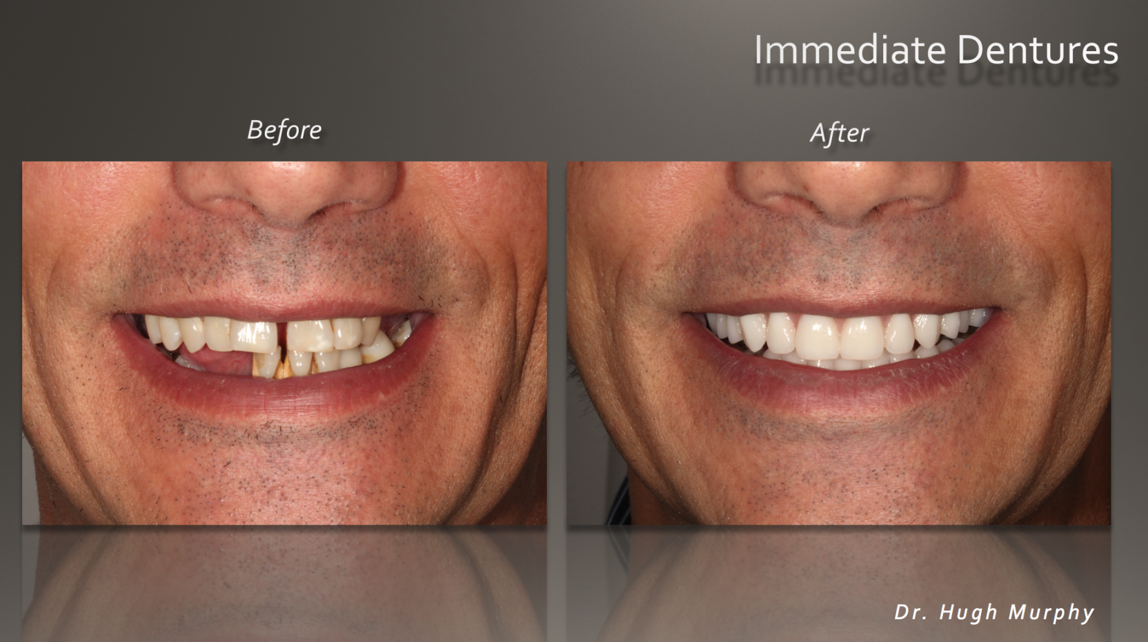 Before and after comparison of immediate dentures by Dr. Hugh Murphy at Premier Prosthodontics, showing a transformation from missing and damaged teeth to a full, natural-looking smile.