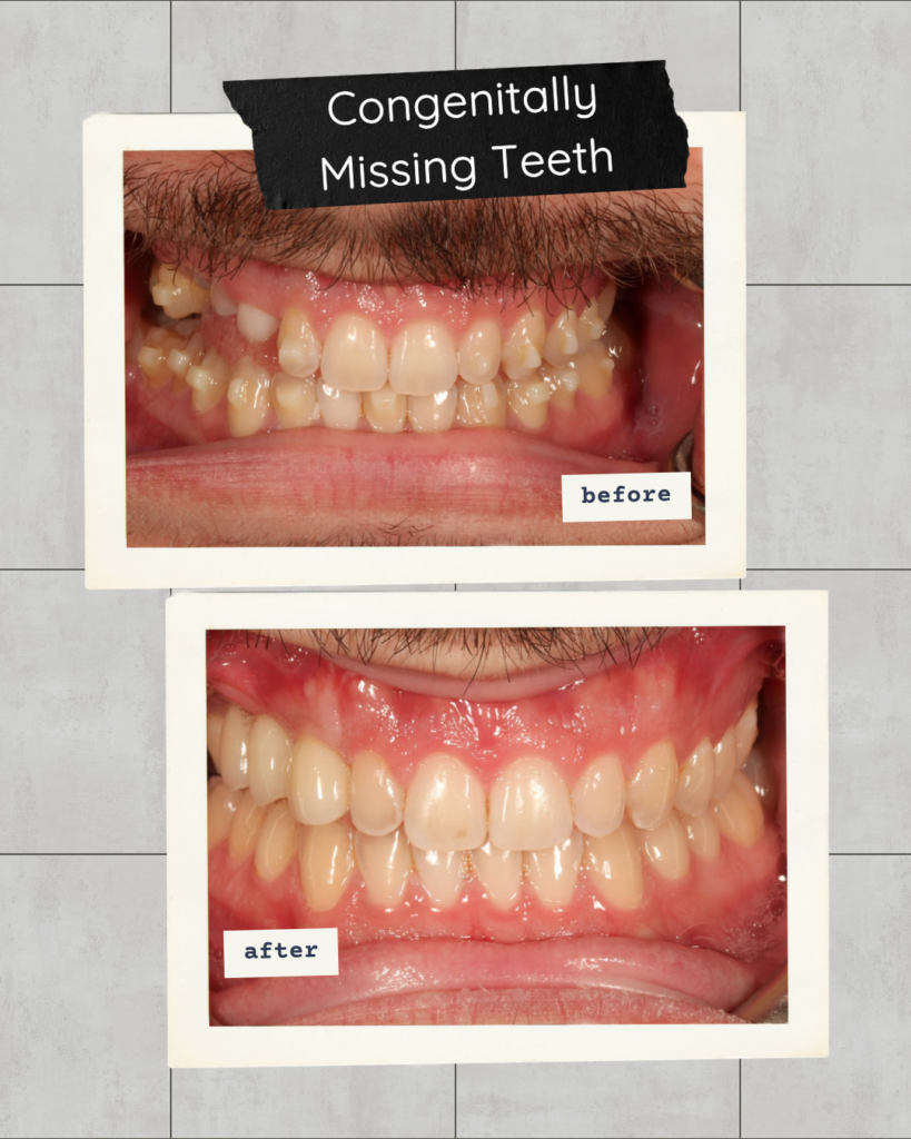 A detailed 'before and after' dental transformation comparison presented in two vintage-style polaroid frames. Top photo shows gapped, uneven natural teeth with labels for "Congenitally Missing Teeth". Bottom photo shows a complete, aligned, prosthetic smile with uniform teeth. Both against a light grey tiled background.