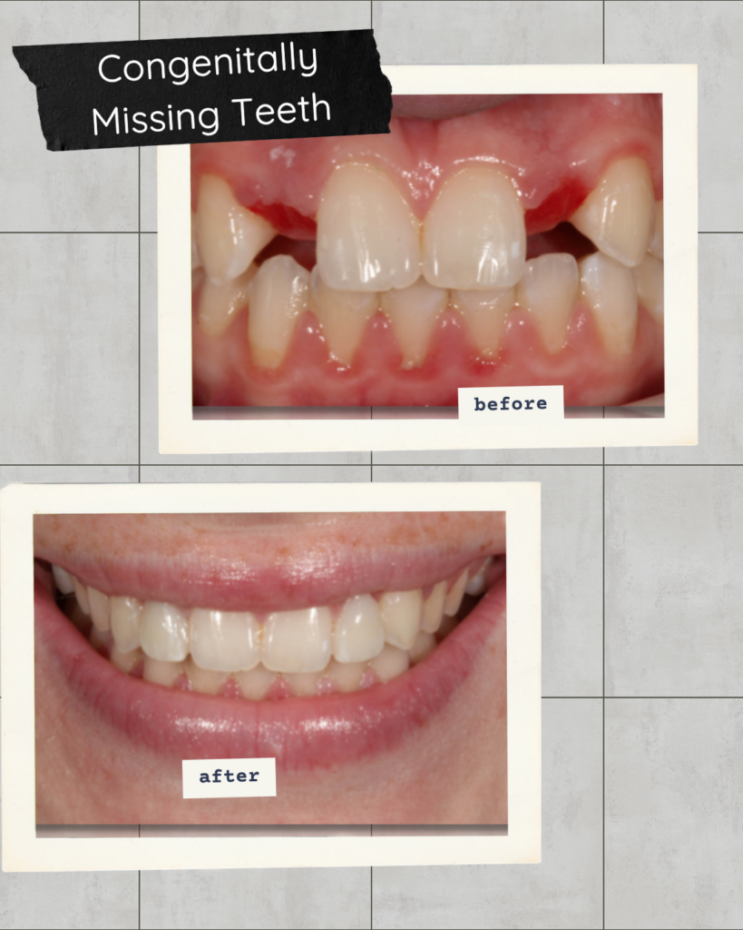 A side-by-side comparison image showing a dramatic dental transformation. The top image is a close-up labeled 'before', showing misaligned teeth with visible gaps and inflamed red gums. The bottom image is a close-up labeled 'after', featuring a full, bright, and natural-looking smile with healthy gums and no gaps, illustrating successful prosthodontic restoration.