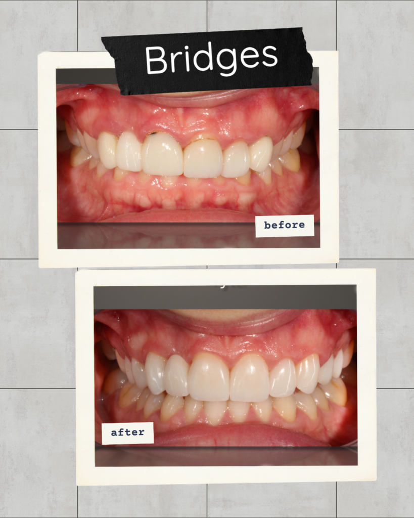 Old, discolored dental bridges with dark margins at the gum line compared to new, custom-fit aesthetic porcelain dental bridges at Premier Prosthodontics in Raleigh.