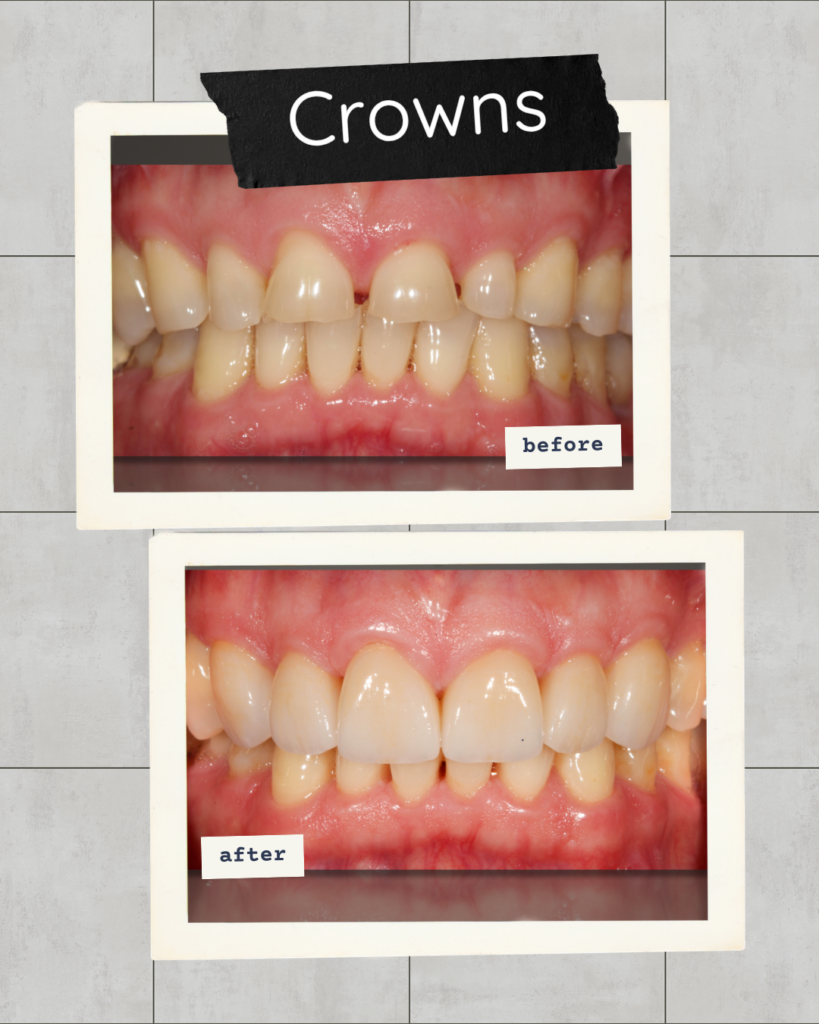 Dental crowns before and after smile transformation at Premier Prosthodontics in Raleigh. Worn upper front teeth are restored to a natural shape, color, and alignment.