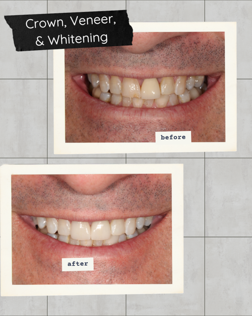 Before and after comparison photos of a male patient's smile makeover in Raleigh, NC. The top 'before' photo shows discolored, yellowed teeth with an uneven smile line. The bottom 'after' photo shows a bright, white, symmetrical smile with natural-looking porcelain veneers and custom dental crowns.