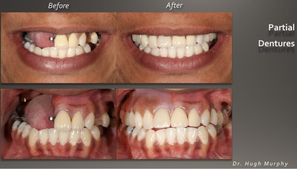 Before and after comparison of a patient smile restoration using custom partial dentures by Dr. Hugh Murphy in Raleigh NC